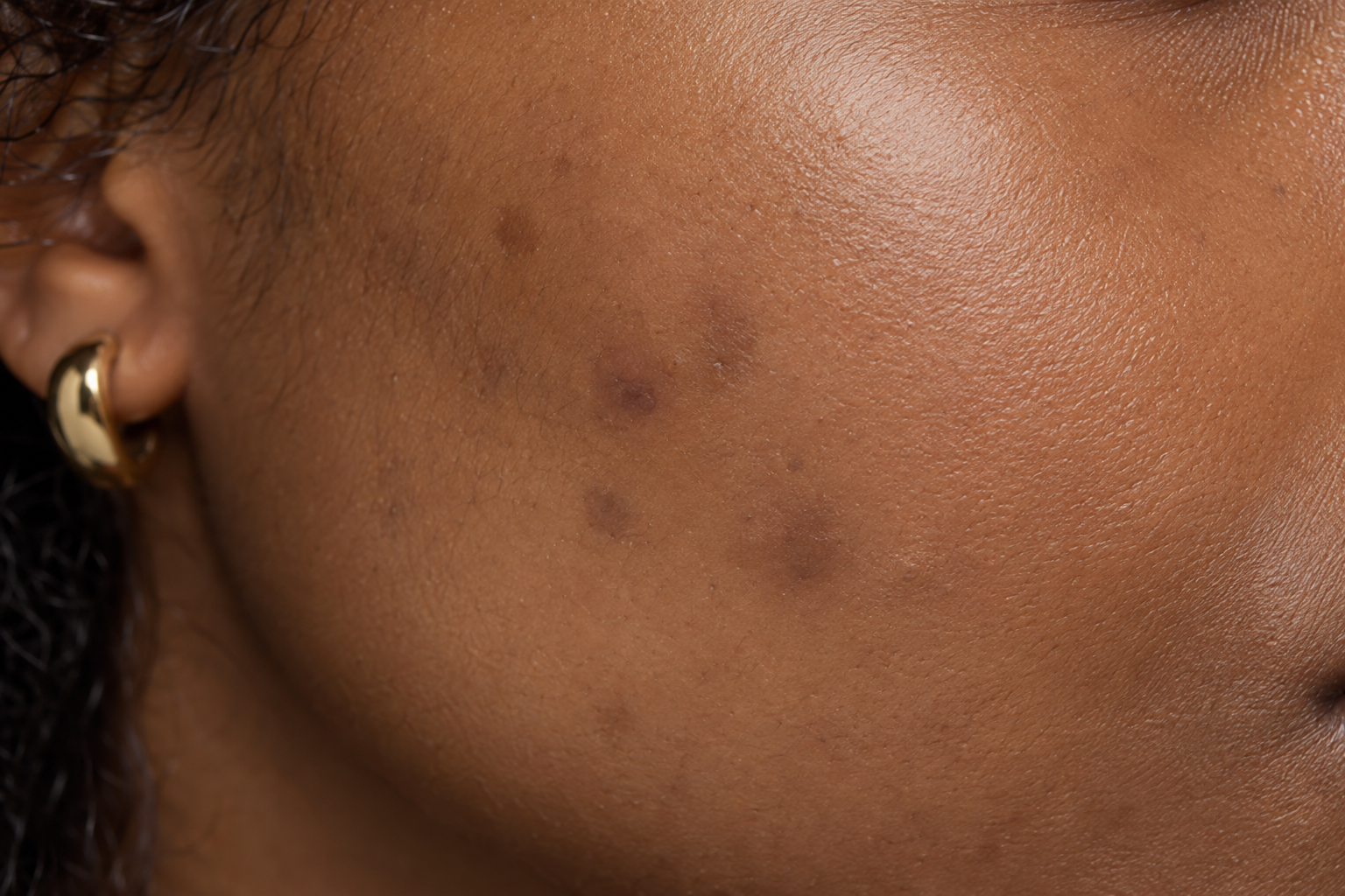 Close-up of a Black woman’s cheek with several flat brown post-breakout marks.